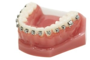 Orthodontic Braces Model