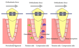 illustration of how braces work