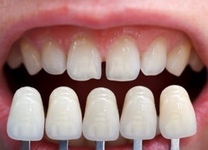 Veneer shade guide held up against teeth