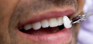 cosmetic dental veneer about to be attached to teeth