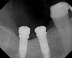 Xray of implants in gum