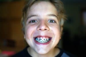 Young boy with severe malocclsuion with traditional braces 