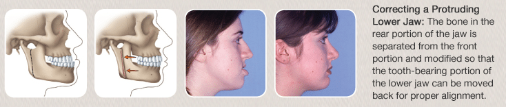 Crrective jaw surgery before and after on lower jaw 