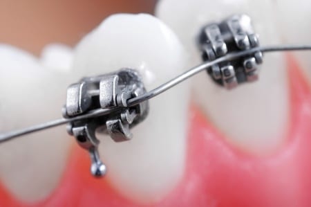 Crooked teeth with traditional braces
