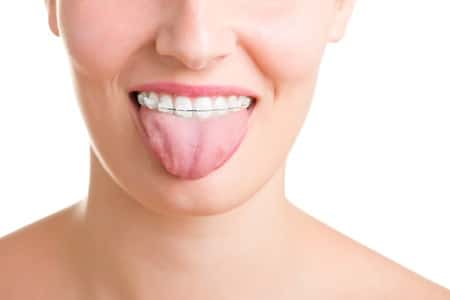 Sticking a tongue out to Braces Risk