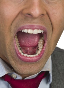 Incognito Hidden Braces on a young business man