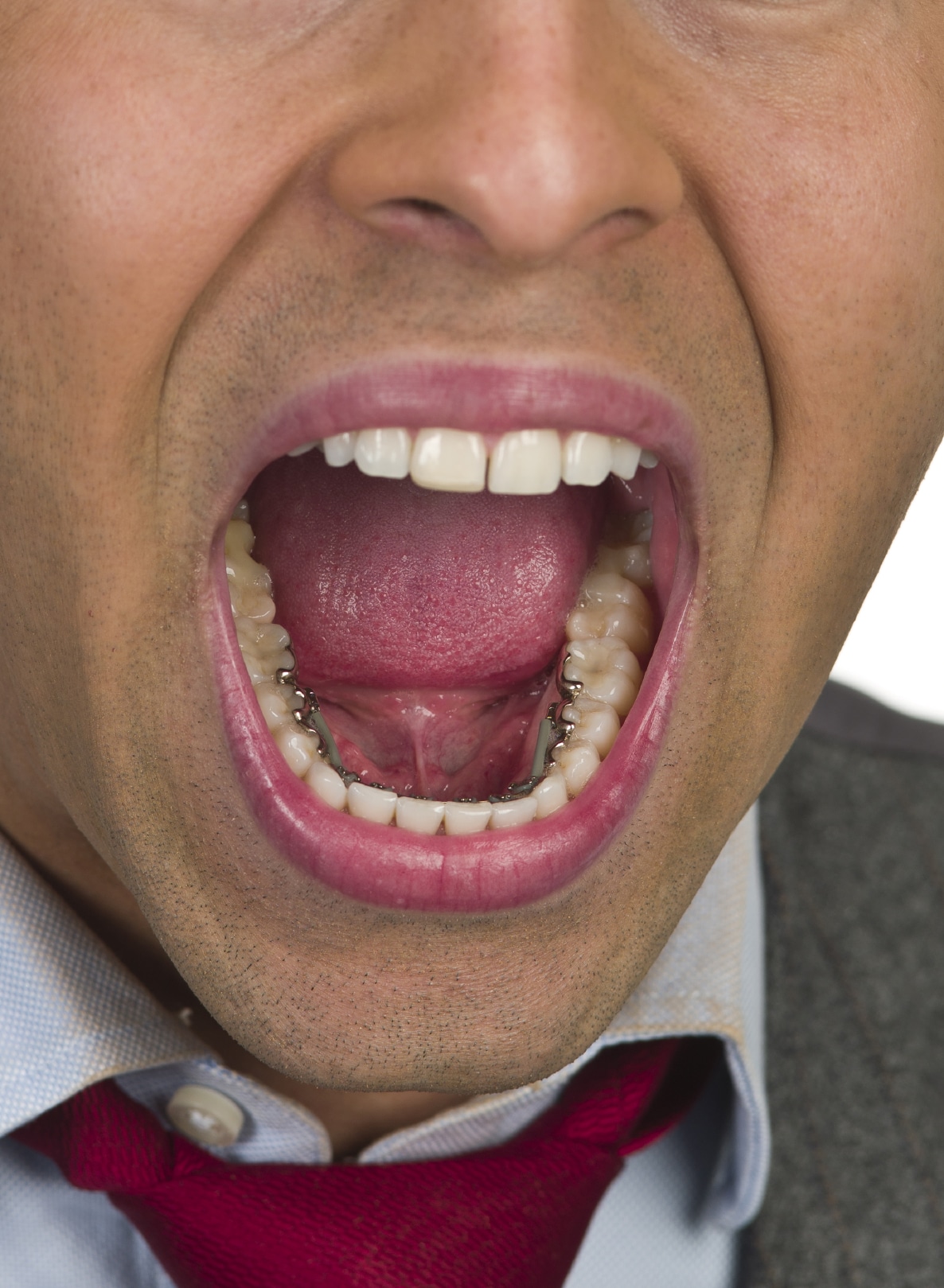 Incognito Hidden Braces on a young business man