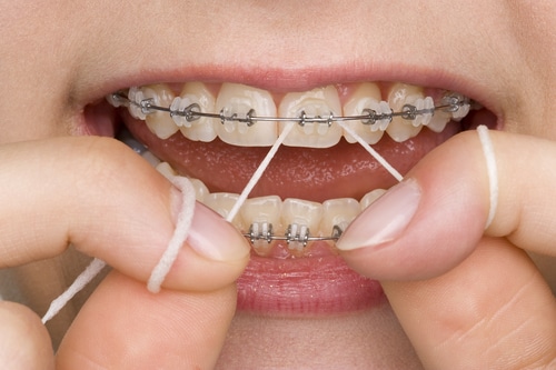 Young lady flosses her teeth and braces