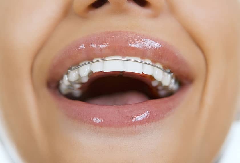 Types Of Retainers For Teeth After Braces at Ana Peterson blog