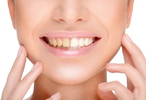 Contrast of whitened teeth and unwhitened teeth