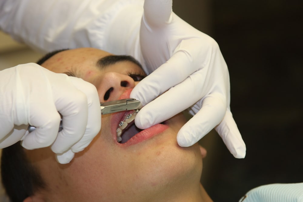 how-are-braces-removed-orthodontic-associates