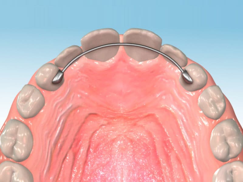 how-long-do-permanent-retainers-last-stroope-orthodontics