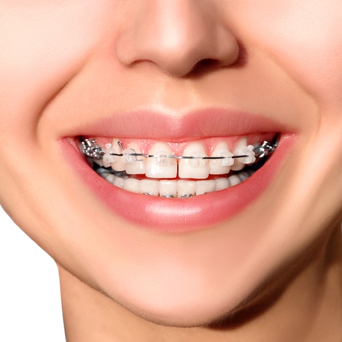 Is There A Best Material For Braces Orthodontic Associates