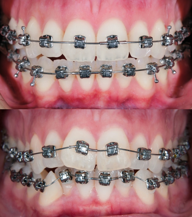 teeth before treatment orthodontic braces stages crooked change different orthodontist children getting dental orthodontics fix jaw smile during ortho catonsville