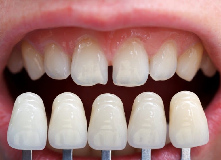 Braces and Veneers What is the Difference? Orthodontic Associates