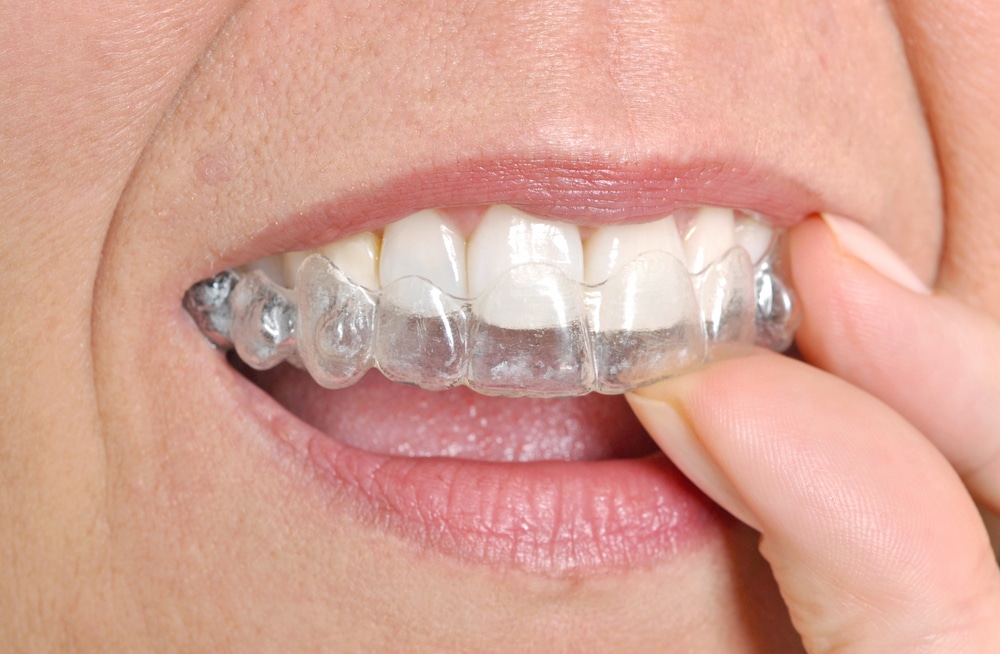 Invisible Alternatives to Traditional Braces | Orthodontic Associates