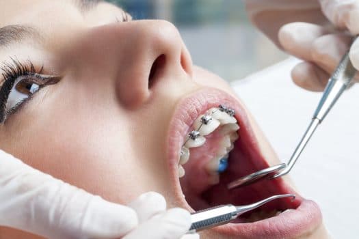 Dentist hands working on young teen patient with dental braces.