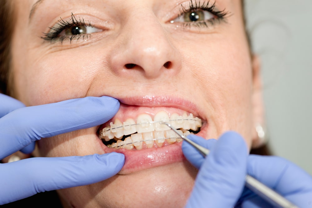 A Guide To Cleaning Teeth With Braces Orthodontic Associates