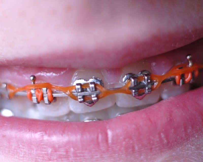 Braces and Power Chains - Orthodontic Associates