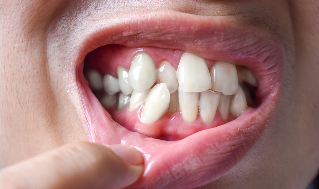 Mouth with Crooked Teeth