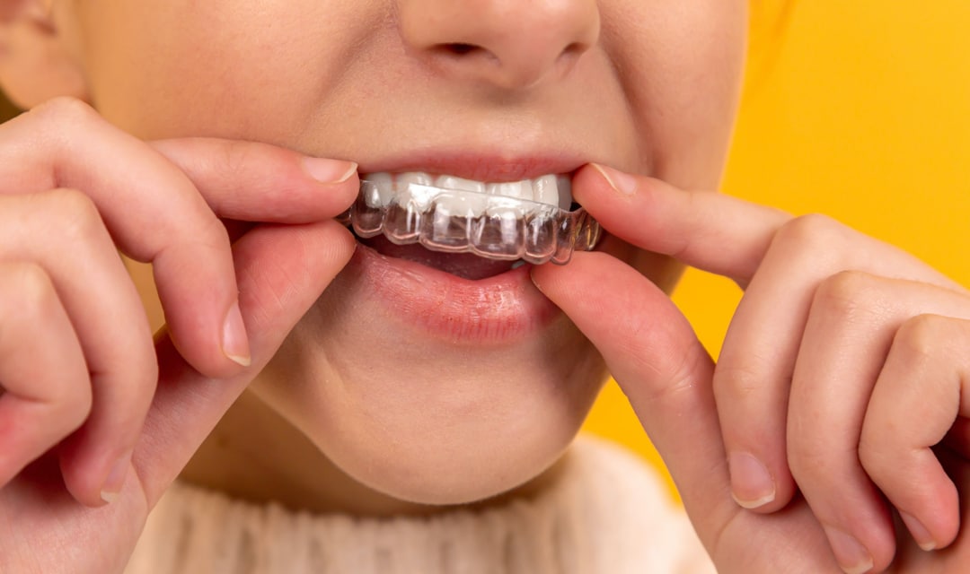 Close Up of a woman's mouth with a retainer